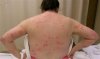 bedbugs.jpg