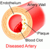 Arterial Blockage.gif